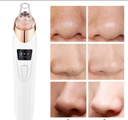 Porex™ Extractor de impurezas faciales